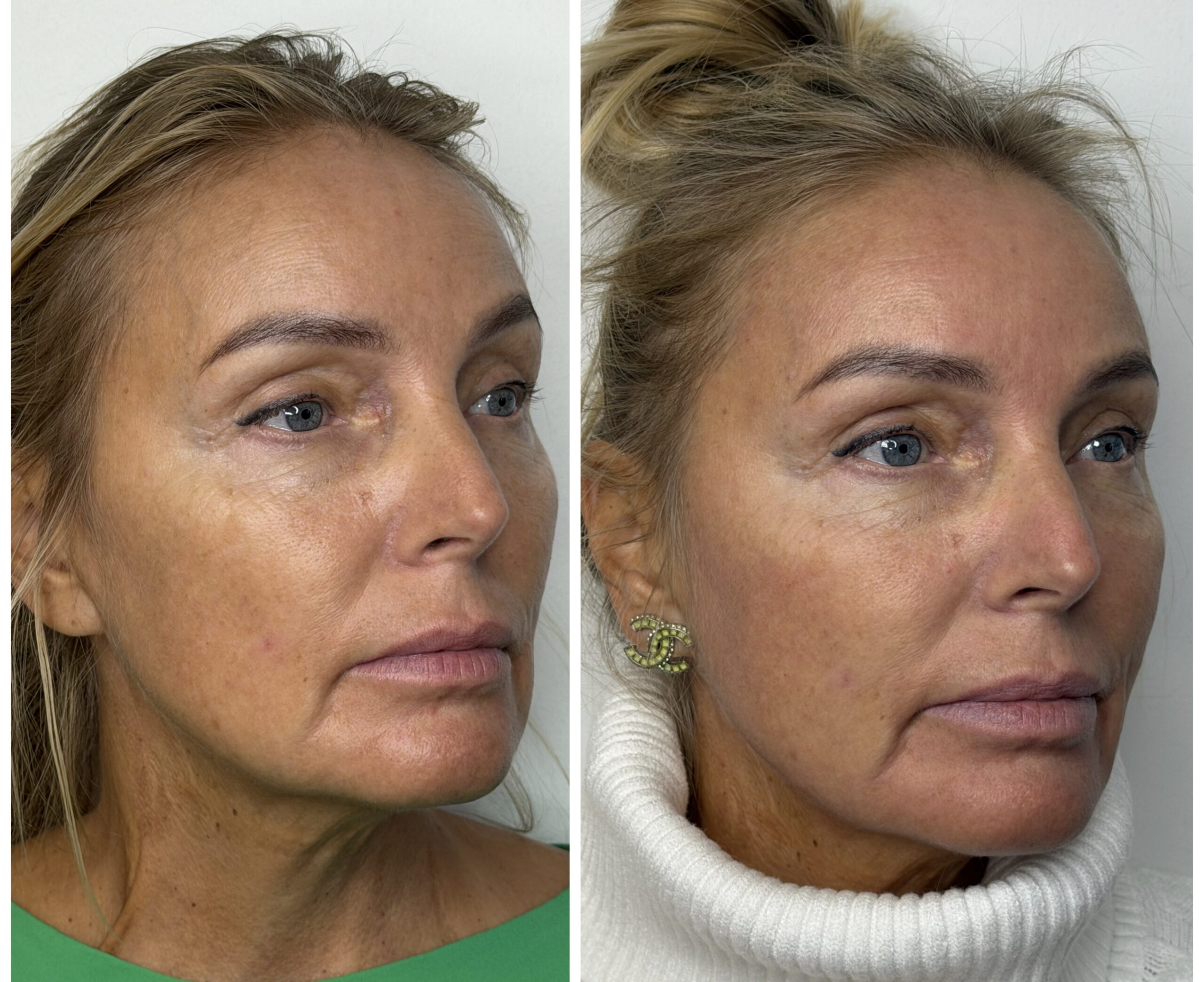 Noorendav mikronõelumine eksosoomidega